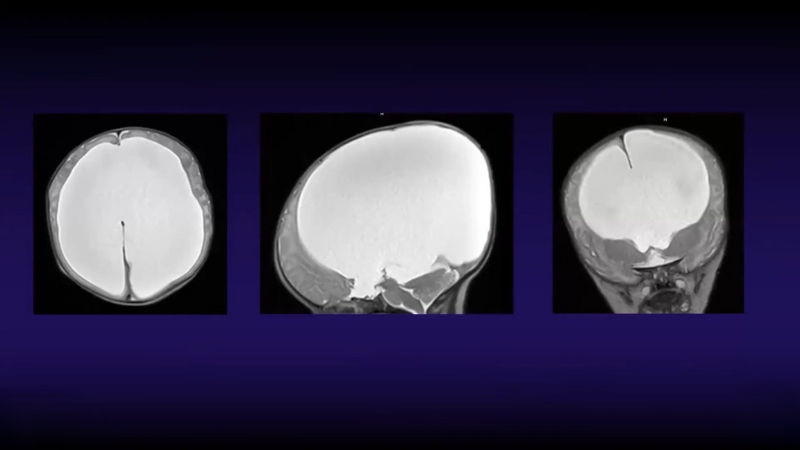 The image shows MRI scans depicting the appearance of potential shunt failure in the brain
