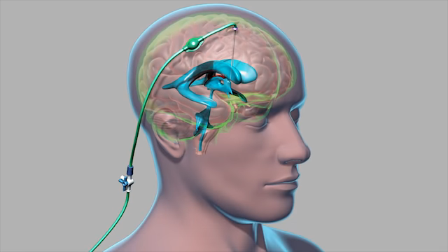 The image shows a diagram of a ventriculoperitoneal shunt replacement procedure