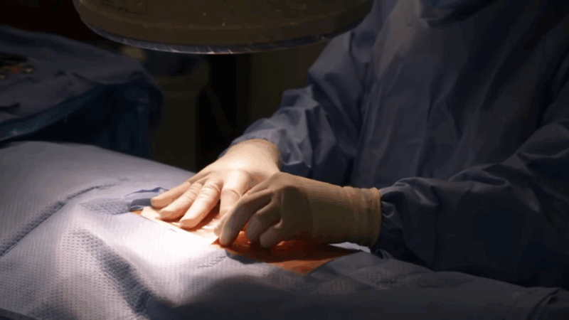 close-up of a surgeon's hands performing a procedure, likely related to the intrathecal pain pump