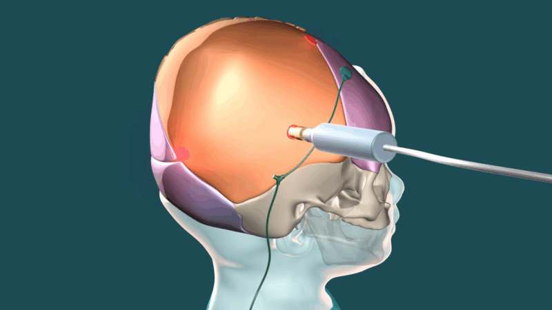 The image shows a shunt being inserted into the skull for medical treatment