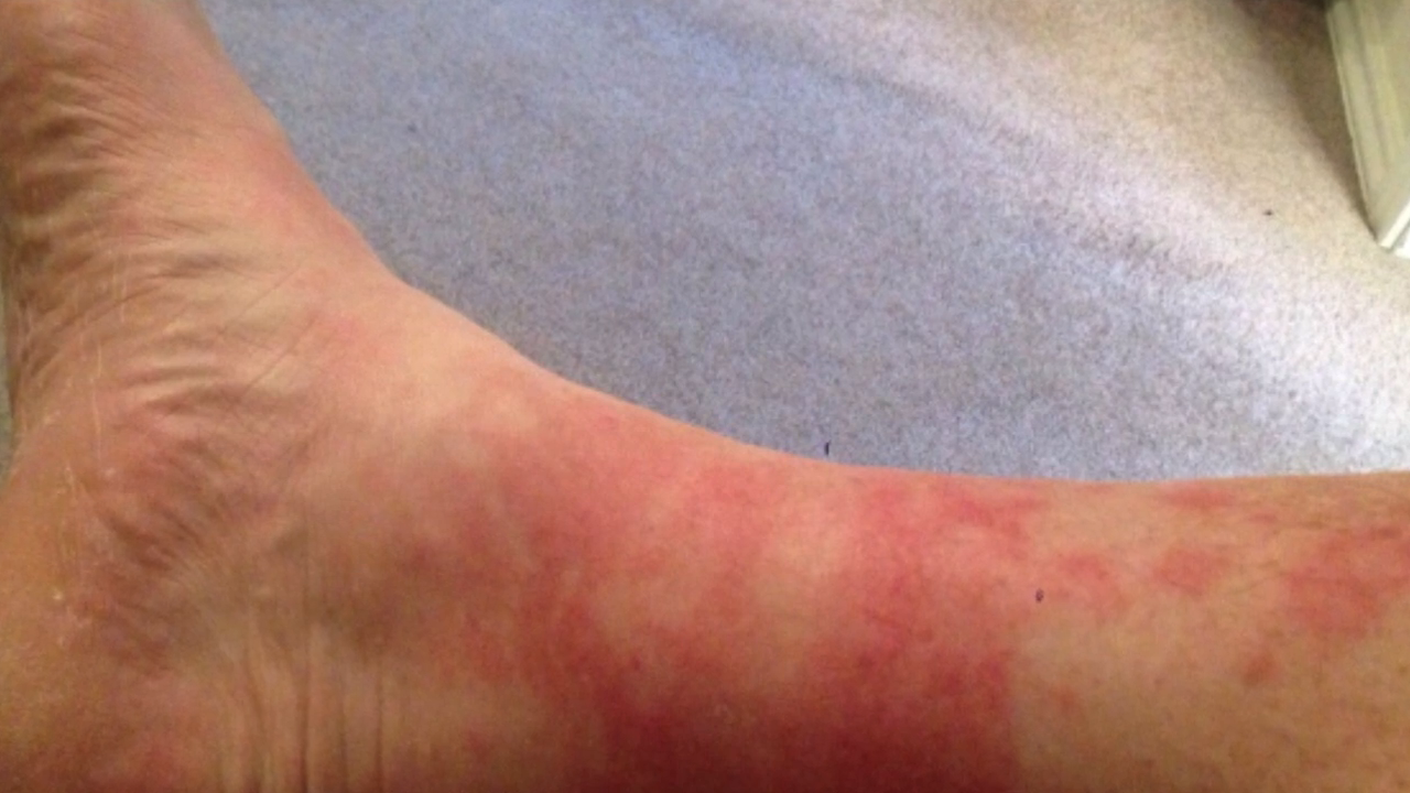 Red, inflamed lower leg showing signs of Disney rash after extended walking in heat
