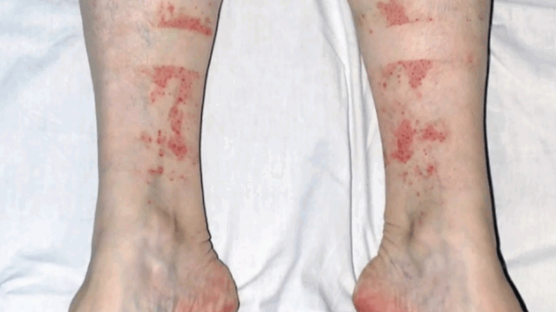 Red patches and petechiae on the lower legs, typical of the Disney rash after prolonged walking in heat