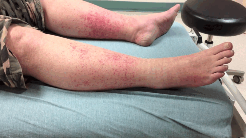 Red, blotchy rash on lower legs caused by prolonged walking and heat exposure, commonly known as the Disney rash